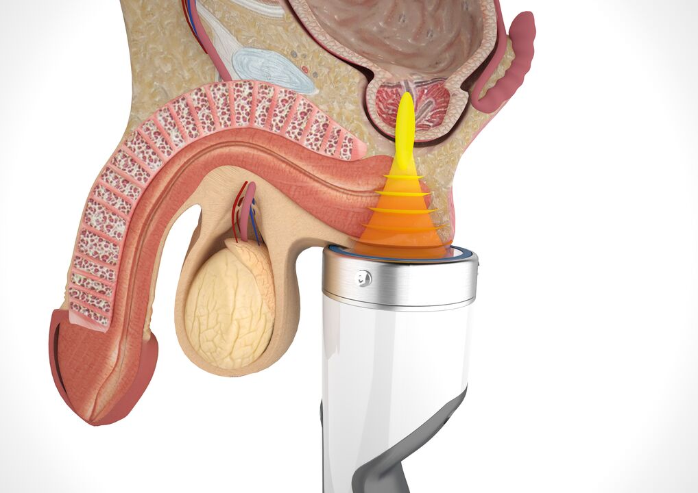 treatment of prostatitis with apparatus