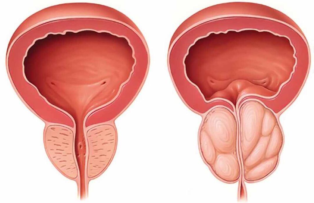 Normal prostate and inflammation of the prostate gland (chronic prostatitis)