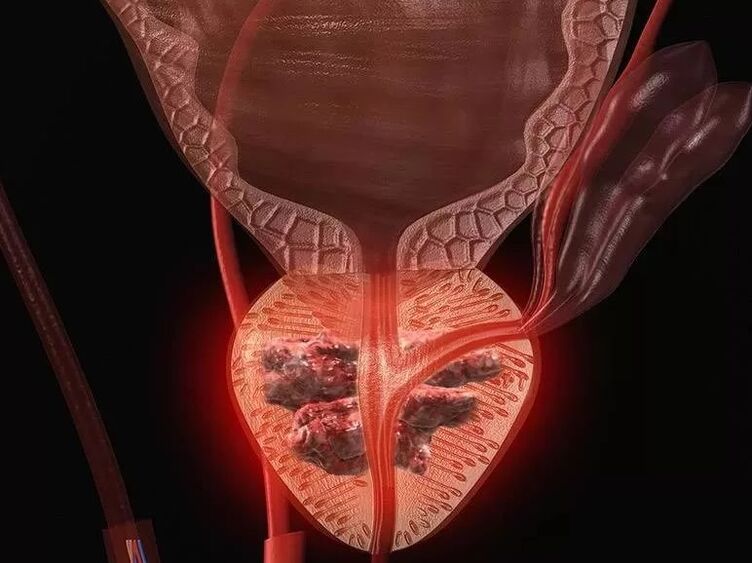 Prostatitis to men