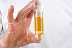 Urine analysis is one of the methods for diagnosing prostatitis