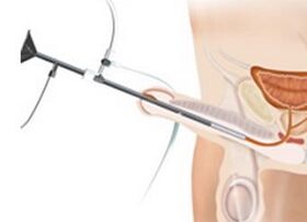 methods of treating prostatitis in men