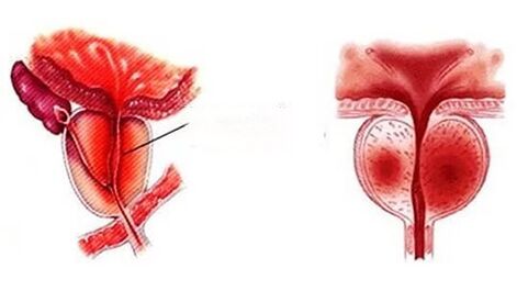 How chronic prostatitis looks